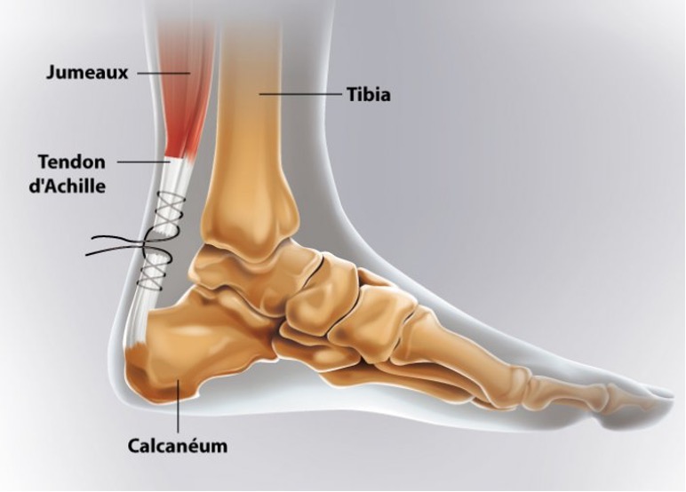 Opération du tendon d'Achille